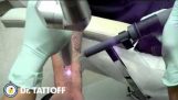Laser rimozione tatuaggio