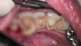 Чистки зубов с большими каменными проблема