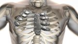 एक कैंसर रोगी के लिए 3D मुद्रित पार्श्व